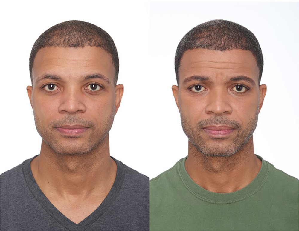 Bosley patient Vincent D before and after