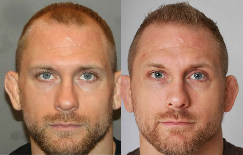 Bosley patient Zachary O. before and after