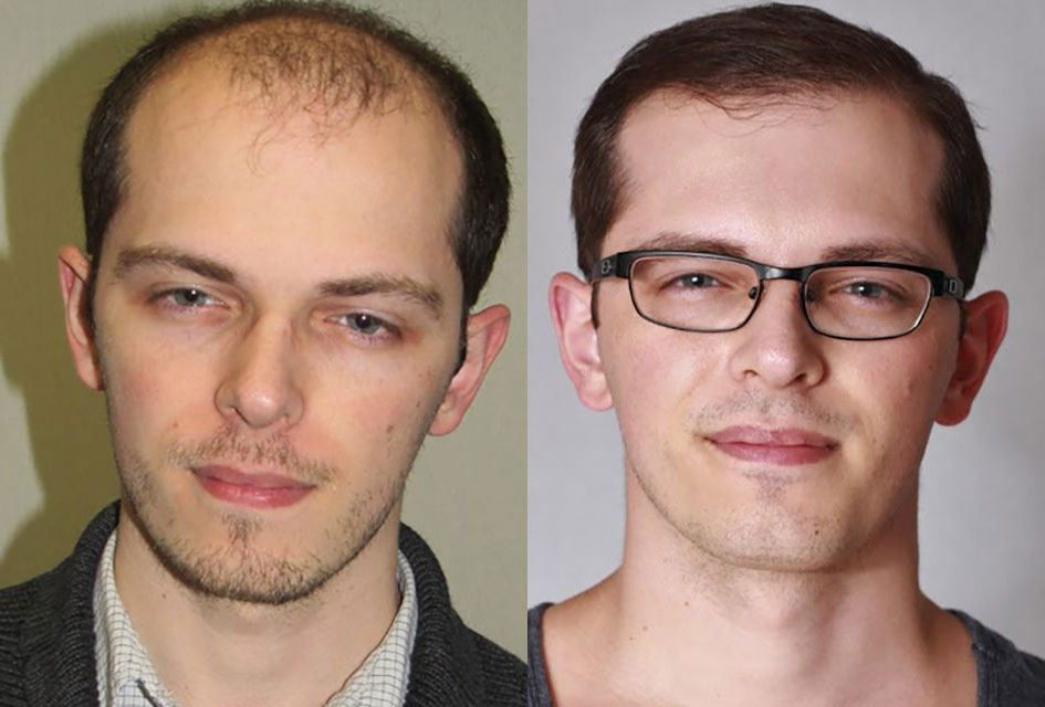 Bosley patient Zachary P. before and after