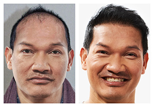 Dee before and after image