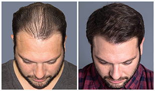 bosley hair transplant near me