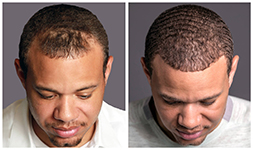 African-American Hair Loss Treatment - Bosley Hair Transplant