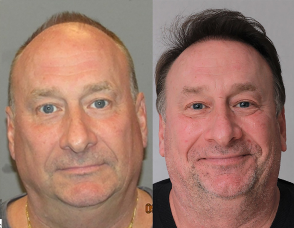 Bosley Patient Bob M. before and after