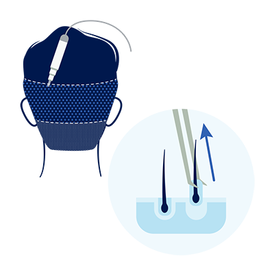 illustration of follicular unit extraction donor area