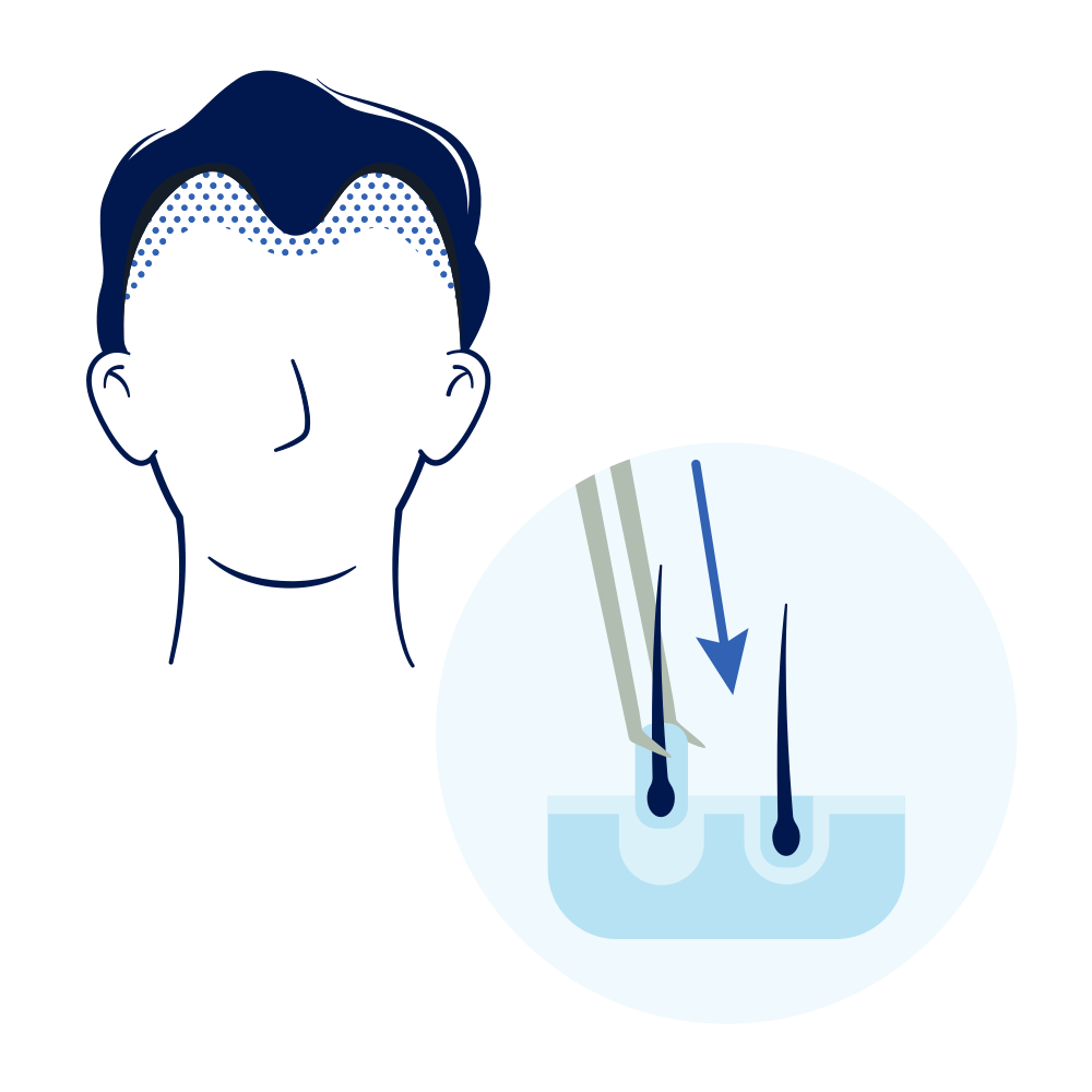 Ilustración de la escisión de la unidad folicular