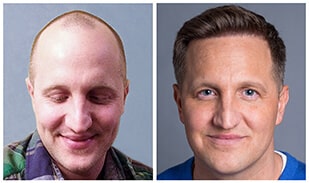 Hair Restoration and Transplants for Men and Women - Bosley Hair Transplant