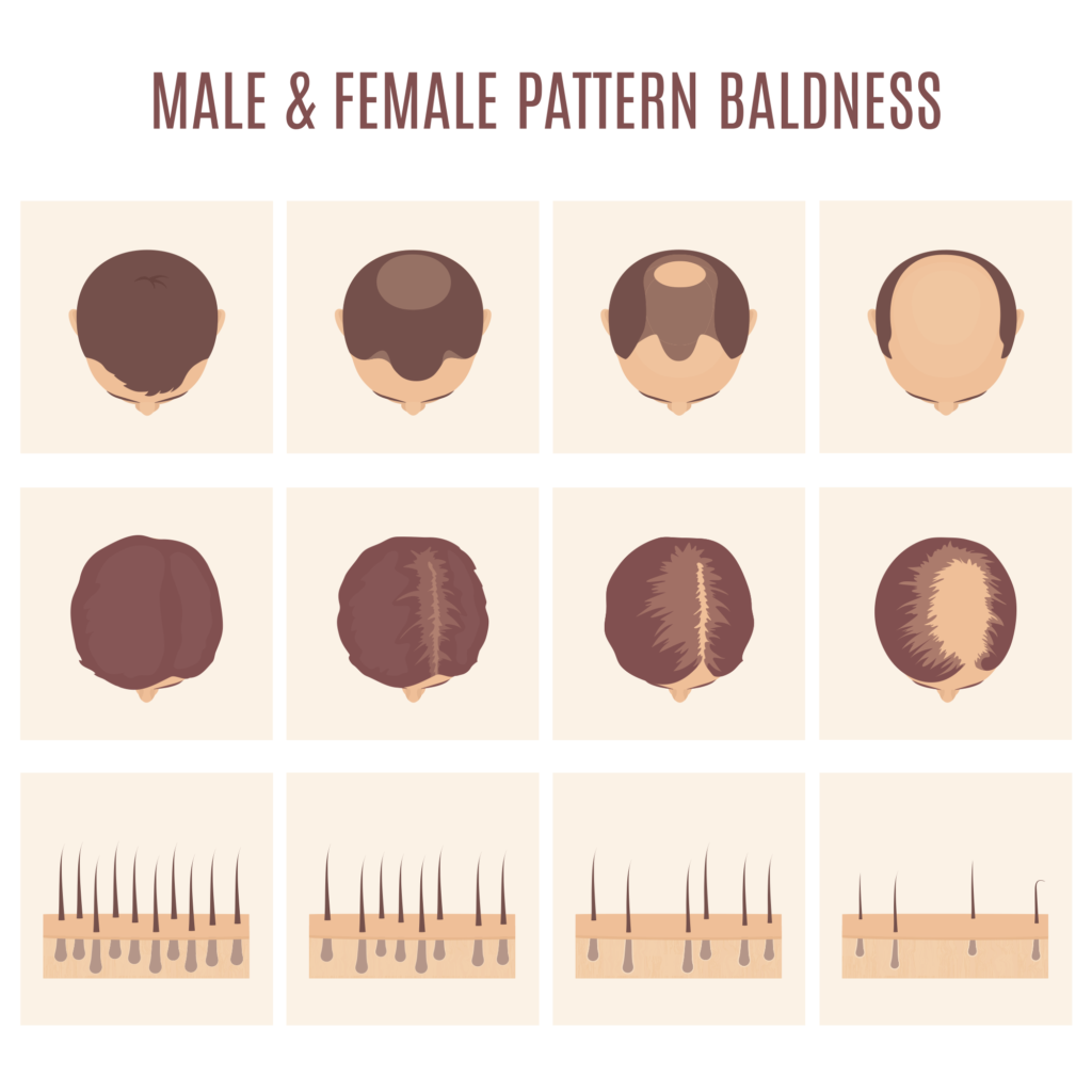 ilustraciones de la calvicie de patrón masculino y femenino