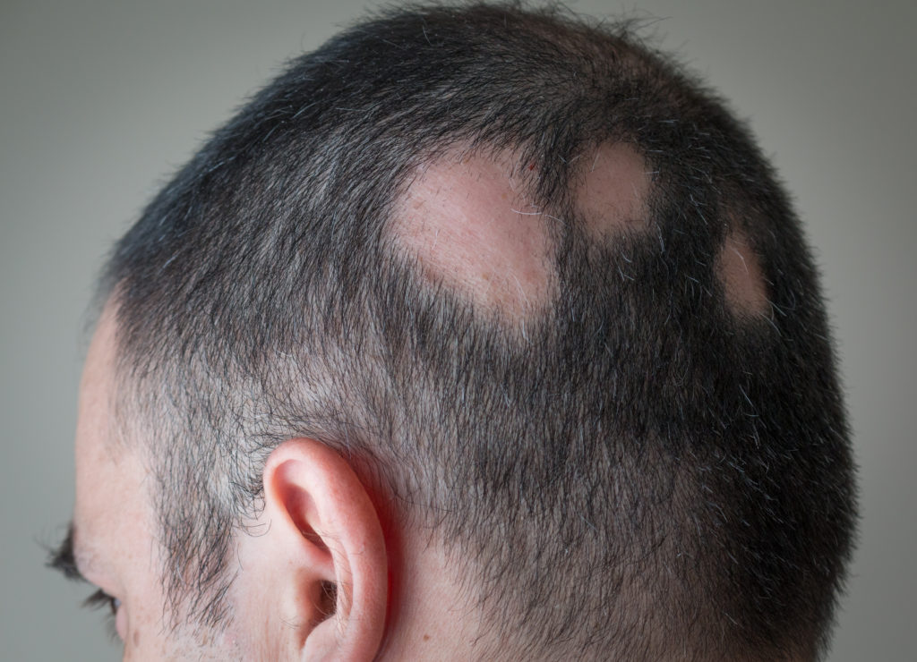 hombre con alopecia aerata