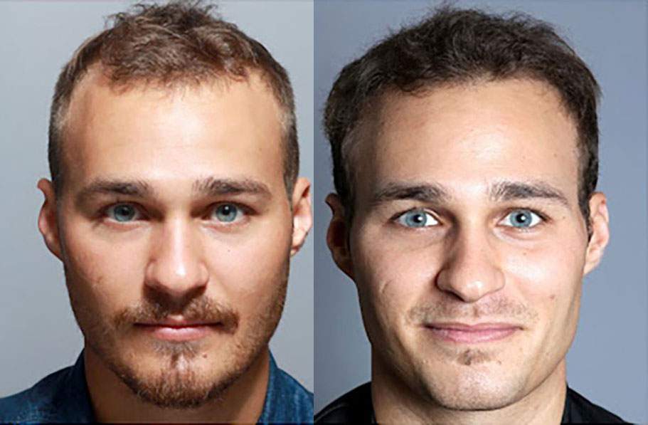 Norwood 3 patient before and after hair transplant
