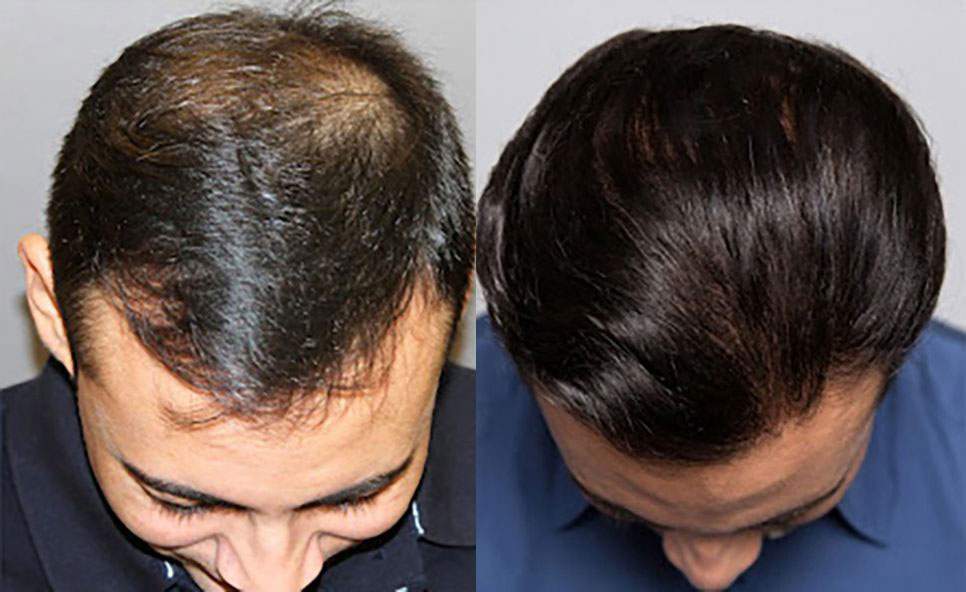 Norwood 4 before and after hair transplant