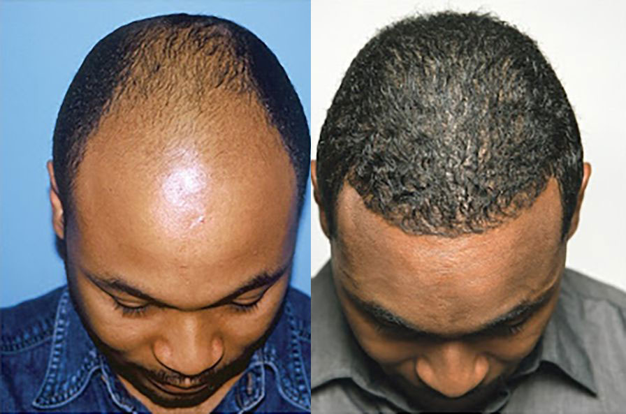 Norwood 5 patient before and after hair transplant