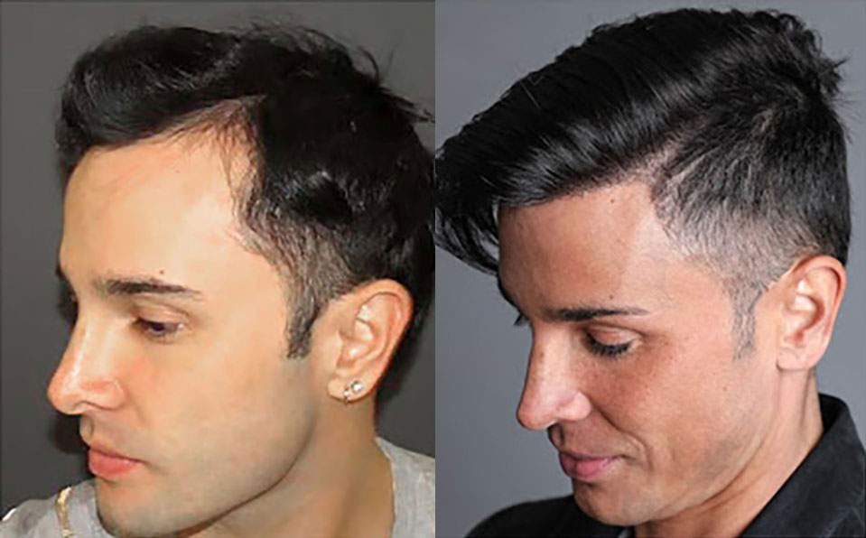 Norwood 2 before and after hair transplant