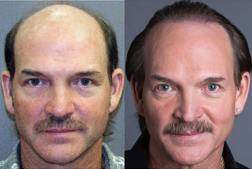 Norwood 7 patient before and after hair transplant