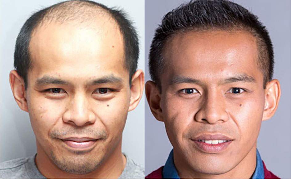 Norwood 6 patient before and after hair transplant