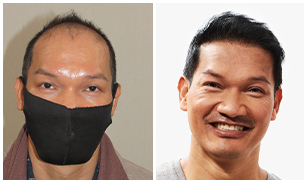 Dee before and after image