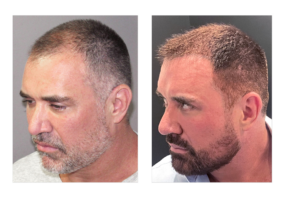 El entrenador Mike Bayer antes y después del trasplante capilar