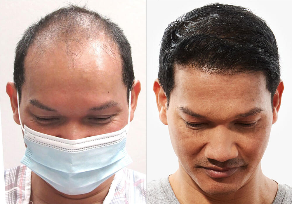 Hair Transplant Before/After Results for Men - Bosley Hair Transplant