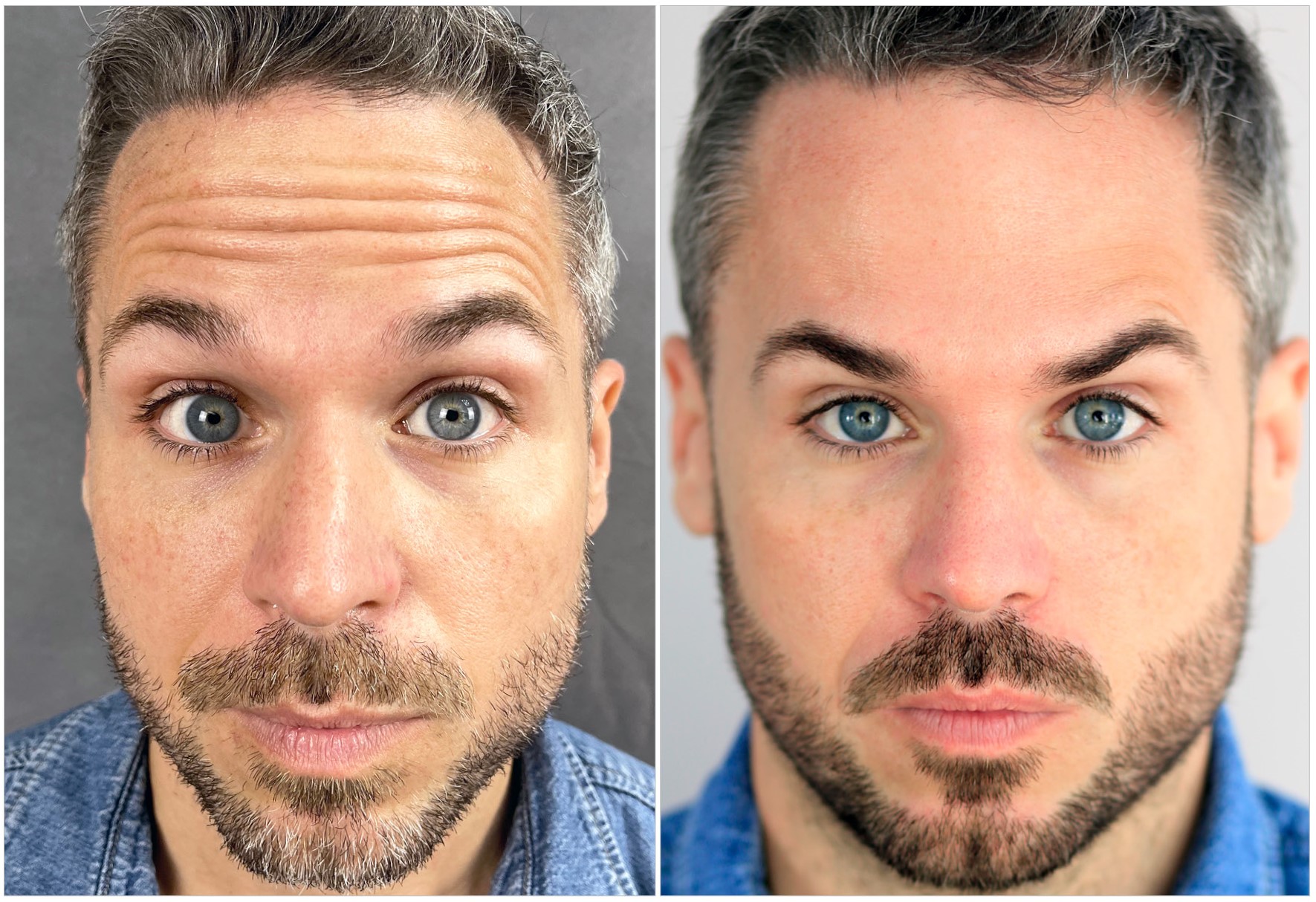 Is Bosley Hair Restoration Worth It Bosley Botox - Bosley Hair Transplant
