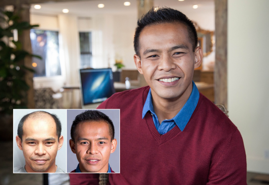 Ron C. Paciente real de Bosley Hair Transplant Beverly Hills. Los resultados individuales pueden variar.