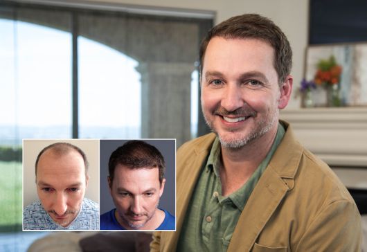 Paciente de Chuck I. Bosley Hair Transplant Kansas City. Los resultados individuales pueden variar.