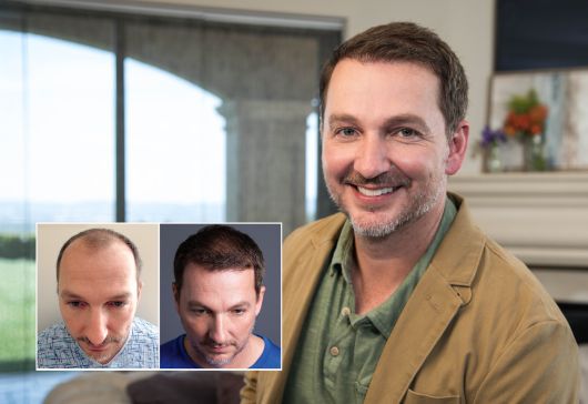 Chuck I. Bosley Hair Transplant Kansas City Patient. Individual results may vary.