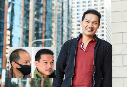 Dee X. Bosley Hair Transplant Chicago Patient. Individual results may vary