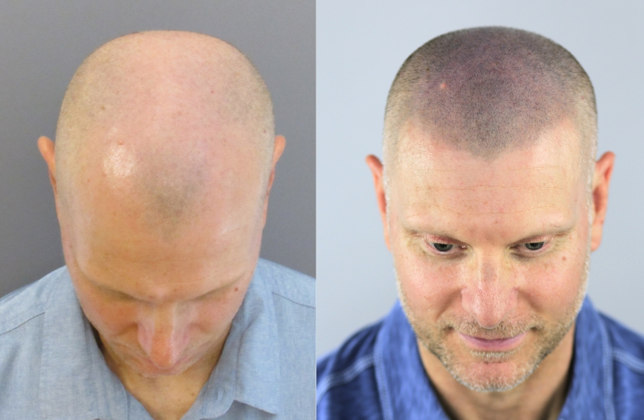 Bosley Patient - Bret S. - SMP