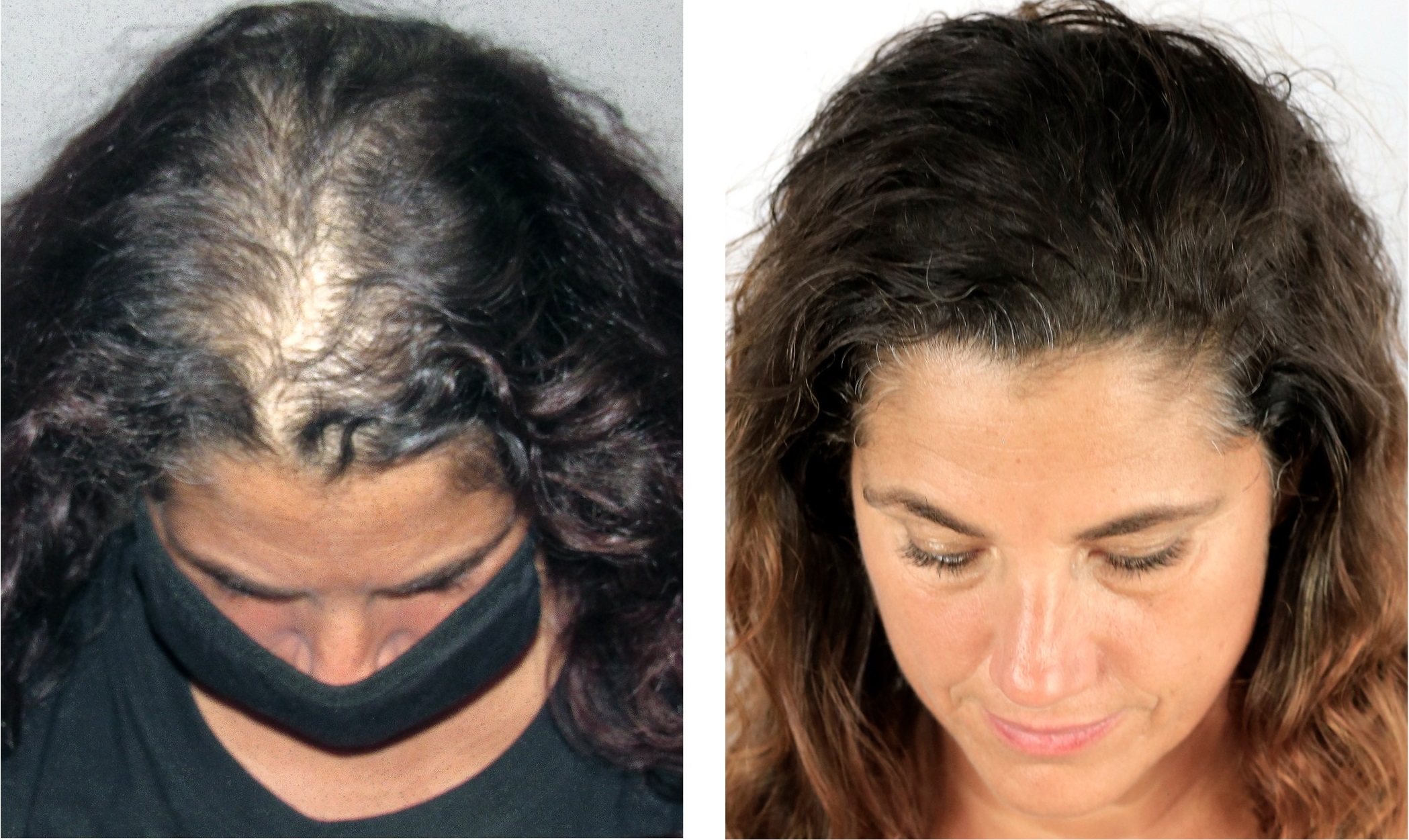 Bosley Patient Charlene D Before and After Images