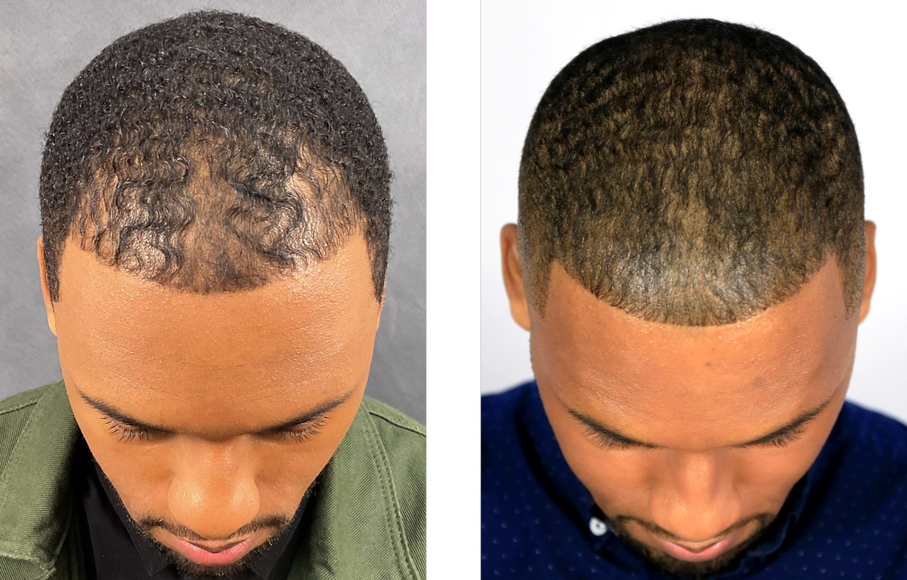 Bosley Patient Julien G Before and After Images