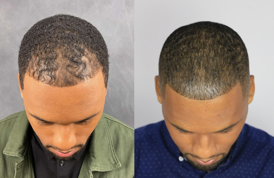 Bosley Patient - Julien G. - SMP