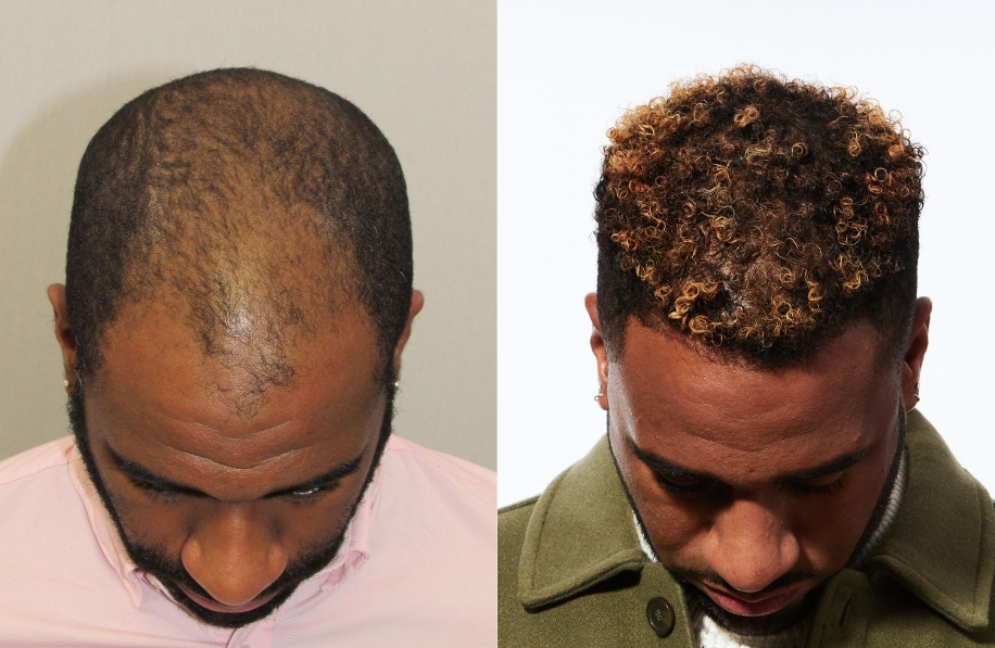 Is Bosley Hair Restoration Worth It Hair Transplant Before/After Results for Men - Bosley Hair Transplant