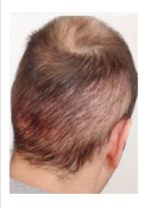 Hair Transplant Overharvest