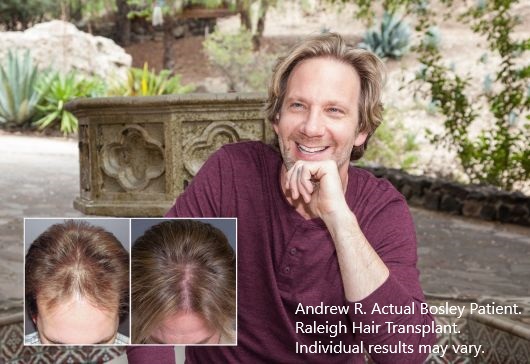 Andrew R. Bosley Hair Transplant Raleigh Patient. Individual results may vary
