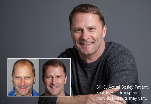 Bill O.  Bosley Hair Transplant Seattle Patient. Individual results may vary.