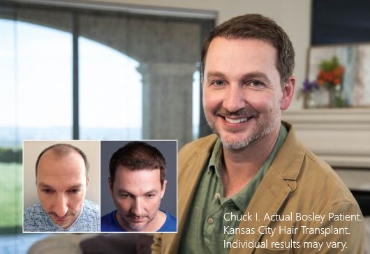 Paciente de Chuck I. Bosley Hair Transplant Kansas City. Los resultados individuales pueden variar.