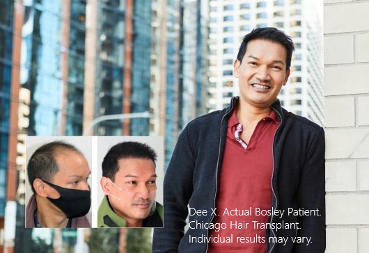 Dee X. Bosley Hair Transplant Chicago Patient. Individual results may vary