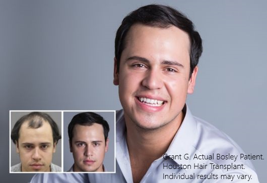 Grant G. Bosley Hair Transplant Houston Paciente. Los resultados individuales pueden variar.