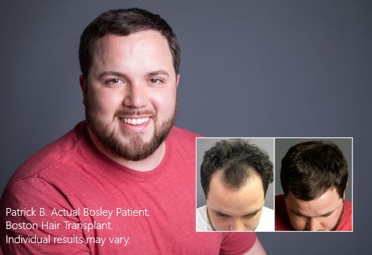 Patrick B. Bosley Hair Transplant Boston Patient. Individual results may vary.