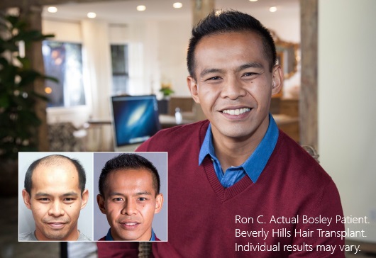 Ron C. Actual Bosley Hair Transplant Beverly Hills Patient. Individual results may vary.