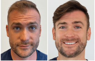 Bosley patient Brandon R. Before and after