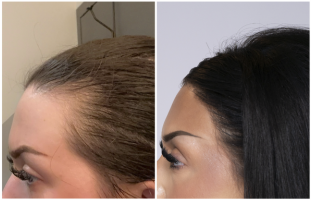 Bosley patient Britany G. Before and after