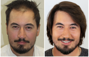 Bosley patient Devin H. Before and after