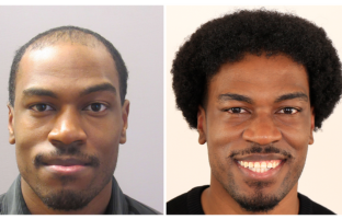 Bosley patient Johnathin R. Before and after