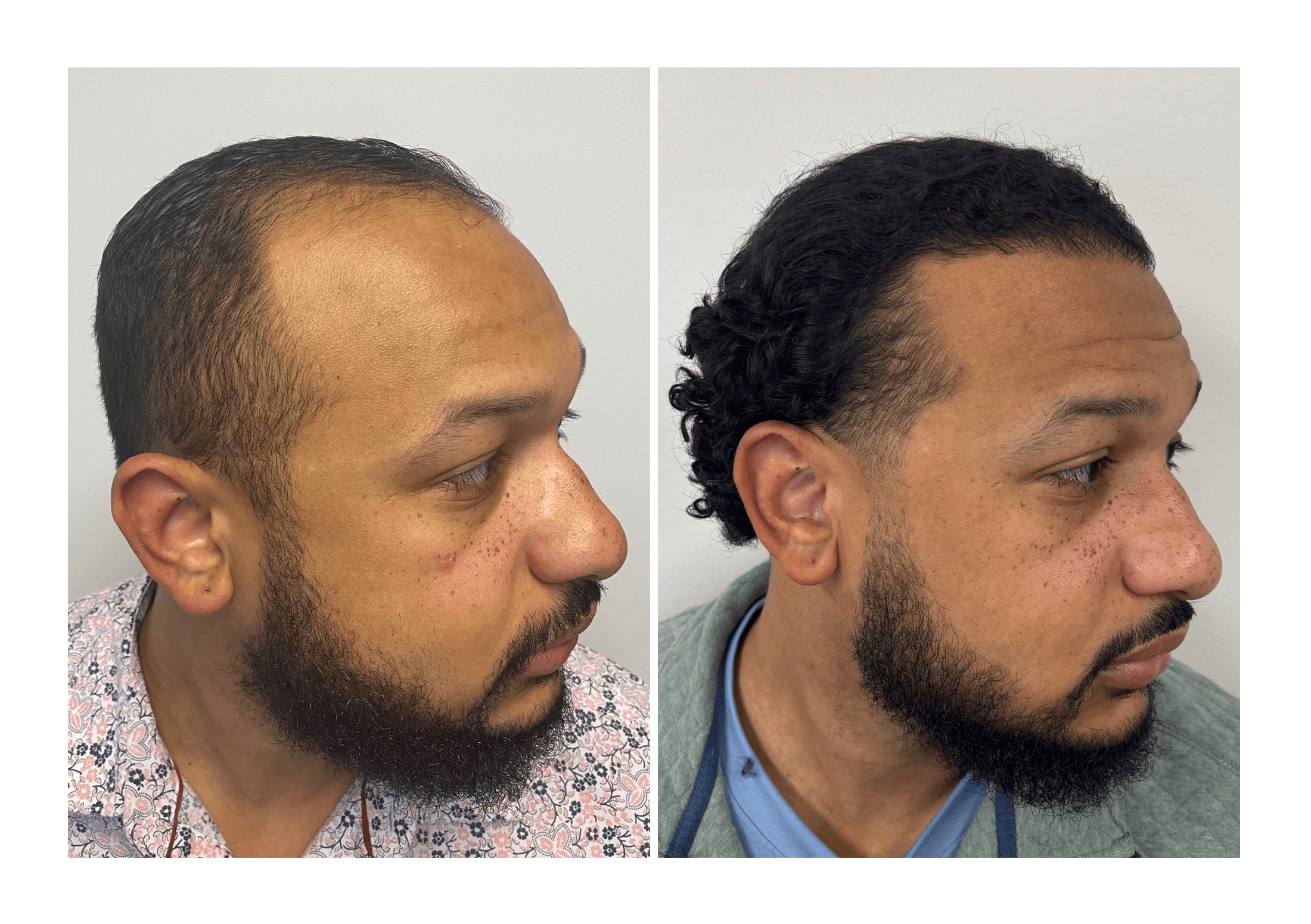 Bosley patient Adrean Johnson - Before and after pictures