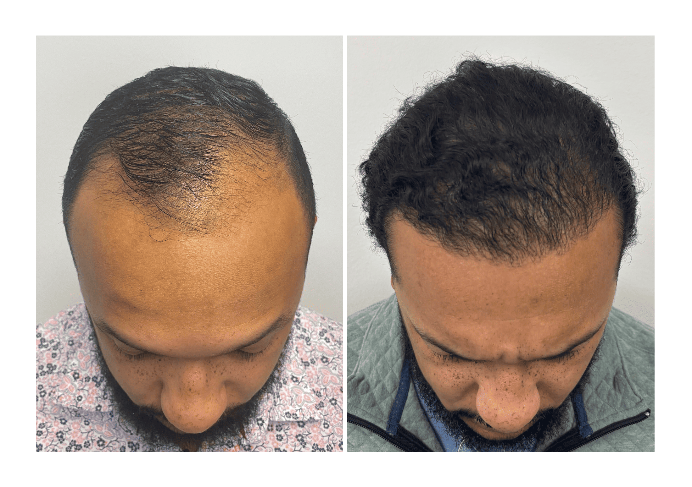 Bosley patient Adrean Johnson - Before and after pictures