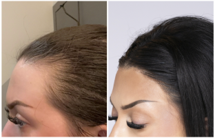 Bosley patient Britany before and after pictures