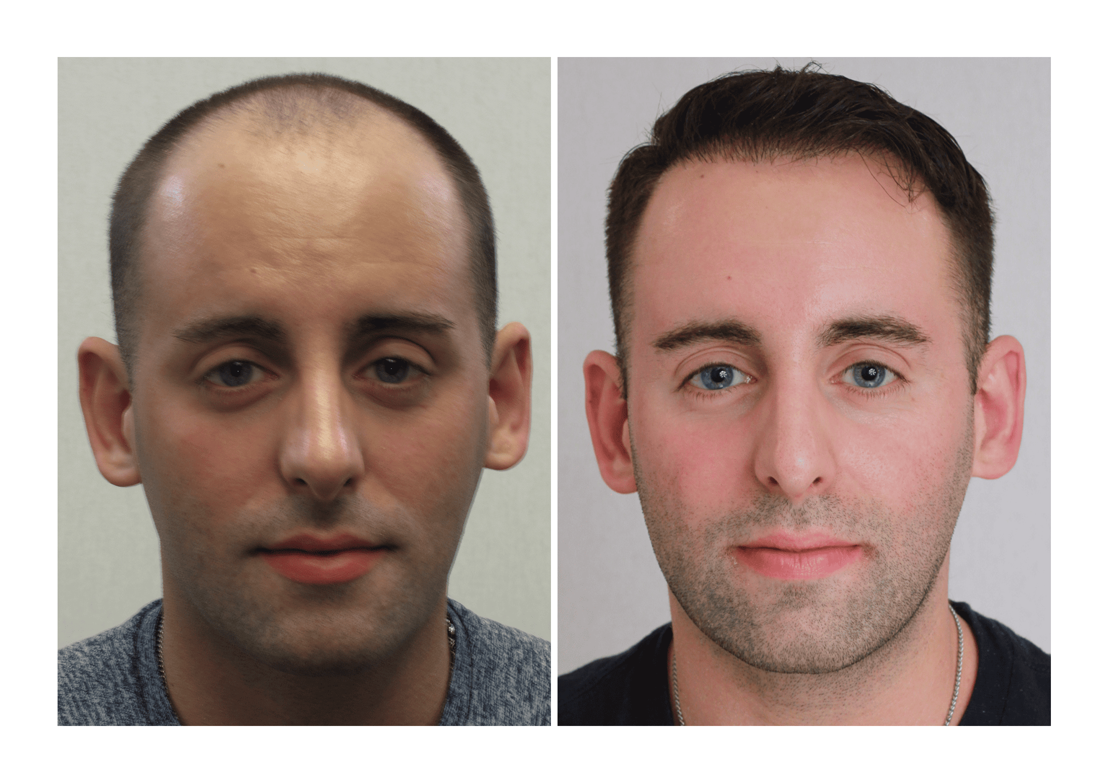 Bosley patient Bryan Elliot - Before and after pictures