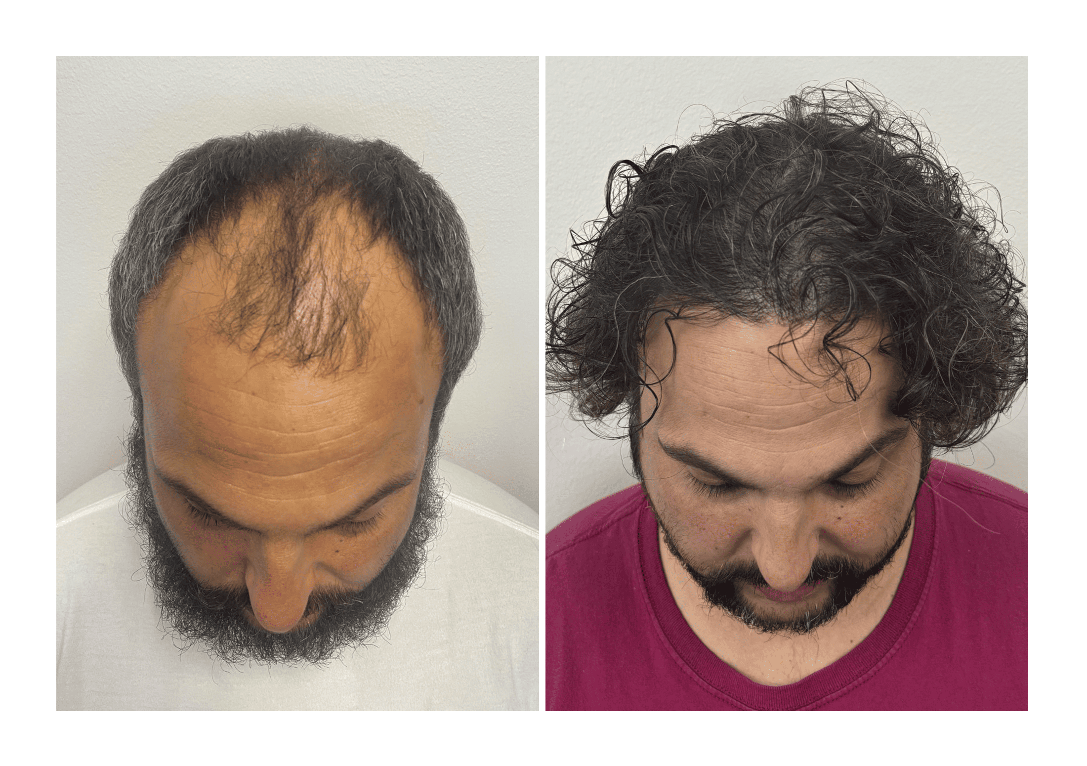 Bosley patient Camron Noonan - Before and after pictures