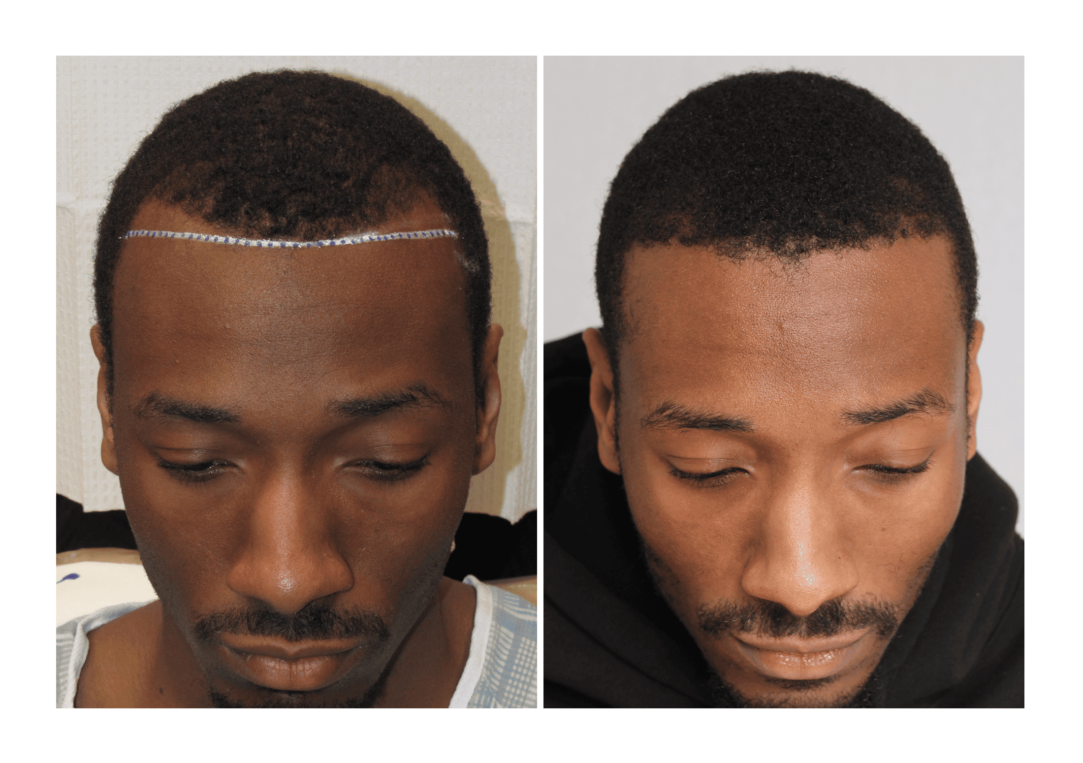 Bosley patient Christopher Conway - Before and after picture