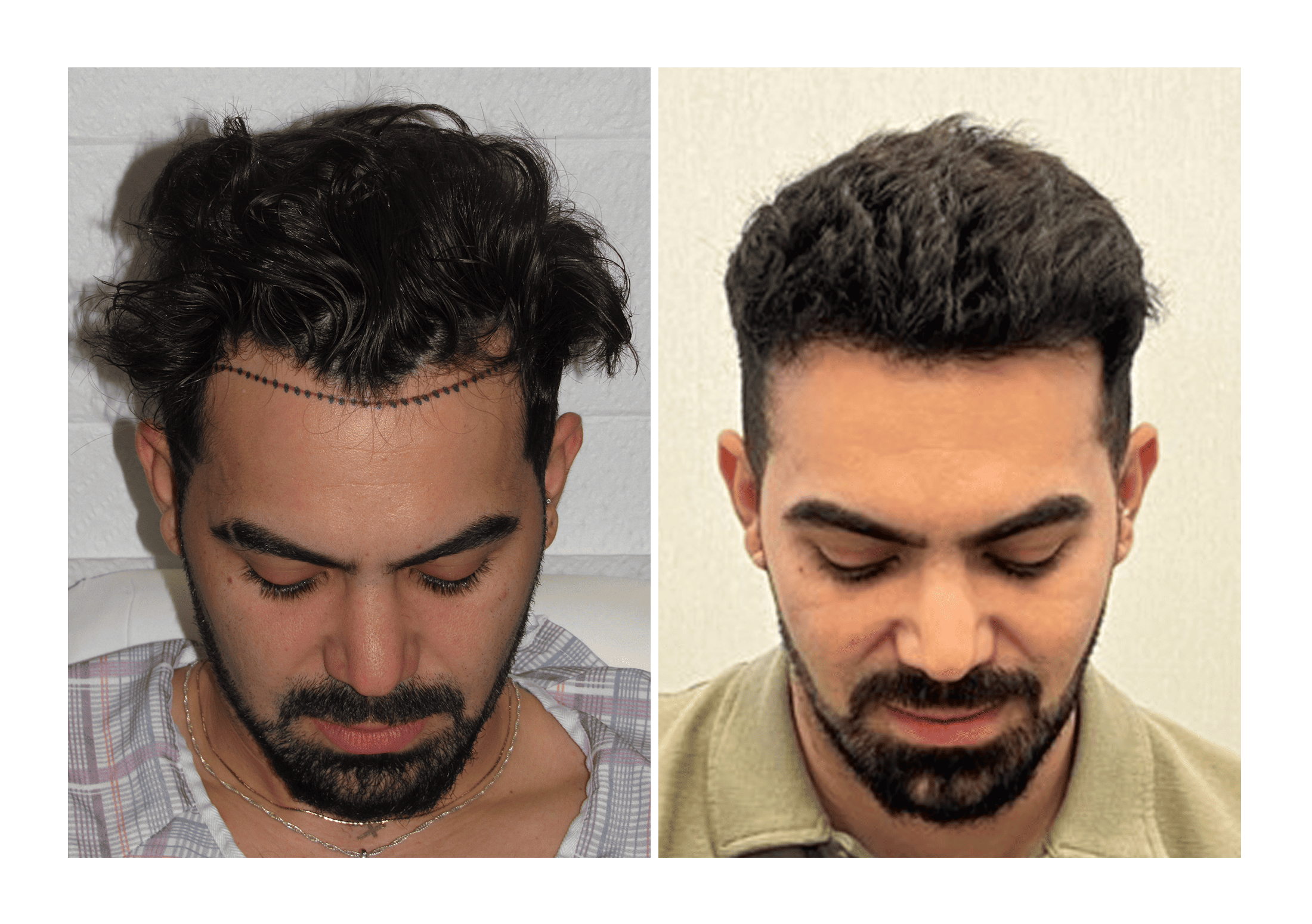 David Spluga before and after pictures